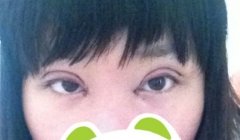 开眼角价格,开眼角的风险 开眼角价格,开眼角的风险