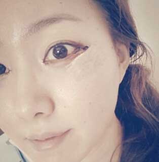 开眼角整形前后全程对比真人果图,整容做开眼角手术的价钱多少
