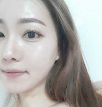 开眼角整形前后全程对比真人果图,整容做开眼角手术的价钱多少