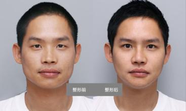 B****一支要多少钱,打B****前后果图