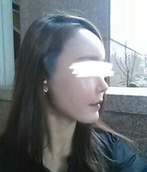 打注射瘦脸B****的价格是多少,注射瘦脸B****副作用