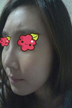 非手术隆鼻费用一般需要多少钱,非手术隆鼻前的注意事项