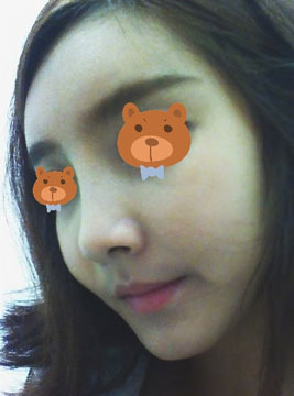 非手术隆鼻费用一般需要多少钱,非手术隆鼻前的注意事项