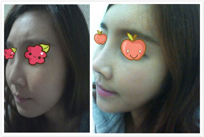 非手术隆鼻费用一般需要多少钱,非手术隆鼻前的注意事项