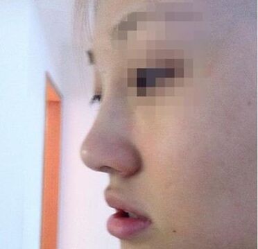 假体隆鼻整形手术大约需要多少钱,假体隆鼻手术能维持多久?