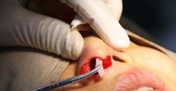 硅胶隆鼻假体取出手术,硅胶隆鼻假体取出手术后的感受