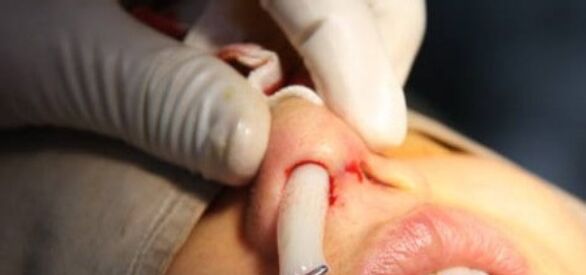 硅胶隆鼻假体取出手术,硅胶隆鼻假体取出手术后的感受