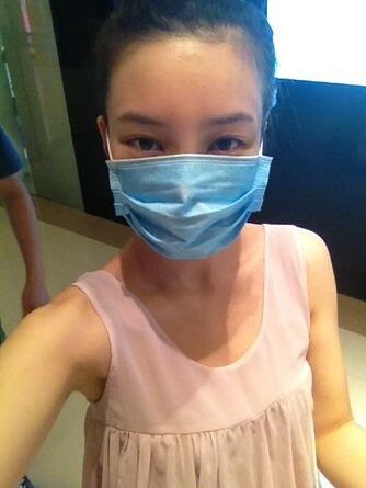 自体耳软骨隆鼻手术价格多少钱费用 自体软骨隆鼻手术会有后遗症吗
