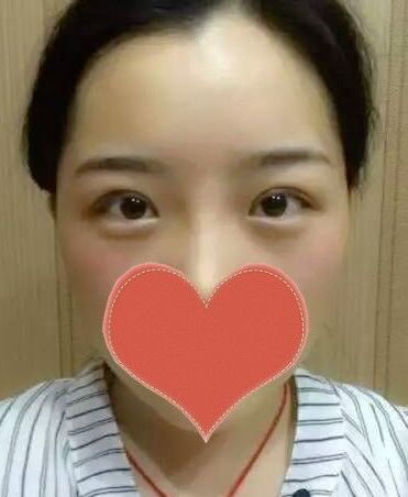 开双眼皮手术有后遗症吗 割双眼皮手术恢复过程果图照片