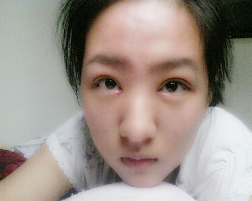 开眼角手术前后对比照片果图 开眼角手术有什么后遗症吗