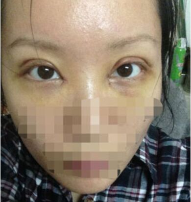 开双眼皮手术有后遗症吗 割双眼皮手术恢复过程照片果图