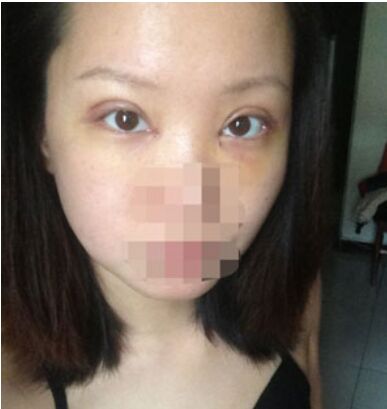 开双眼皮手术有后遗症吗 割双眼皮手术恢复过程照片果图