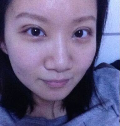 开双眼皮手术有后遗症吗 割双眼皮手术恢复过程照片果图