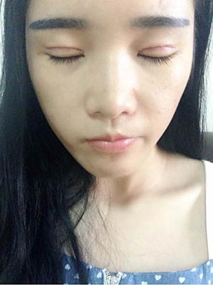 开双眼皮手术有后遗症吗 割双眼皮手术恢复过程照片果图