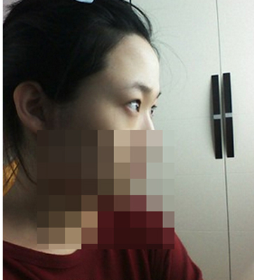 埋线法双眼皮手术果照片图 做埋线法双眼皮后恢复过程组图