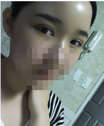 埋线法双眼皮手术果照片图 做埋线法双眼皮后恢复过程组图