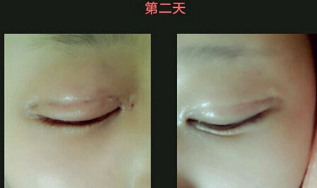做高分子埋线双眼皮手术多少钱 做高分子埋线双眼皮手术注意事项