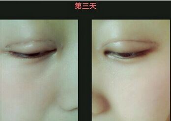 做高分子埋线双眼皮手术多少钱 做高分子埋线双眼皮手术注意事项