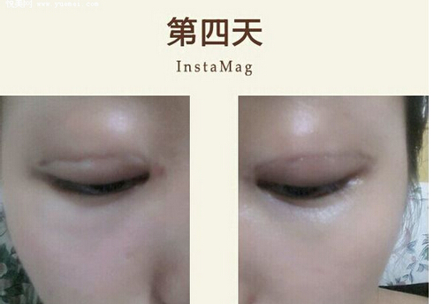 做高分子埋线双眼皮手术多少钱 做高分子埋线双眼皮手术注意事项