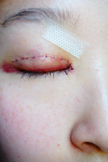 内双适合做双眼皮手术吗 内双割双眼皮好看吗