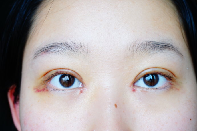 内双适合做双眼皮手术吗 内双割双眼皮好看吗