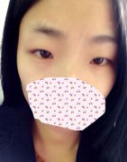 内双适合做双眼皮手术吗 内双割双眼皮好看吗 内双适合做双眼皮手术吗 内双割双眼皮好看吗