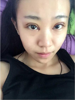 三点定位双眼皮手术的价格多少钱 开双眼皮手术有什么后遗症吗