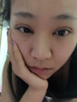 三点定位双眼皮手术的价格多少钱 开双眼皮手术有什么后遗症吗