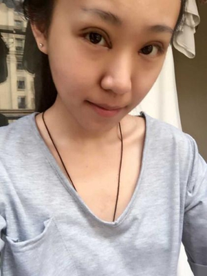 三点定位双眼皮手术的价格多少钱 开双眼皮手术有什么后遗症吗
