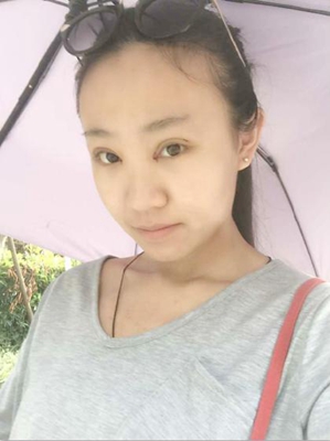 三点定位双眼皮手术的价格多少钱 开双眼皮手术有什么后遗症吗