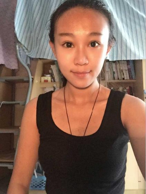 三点定位双眼皮手术的价格多少钱 开双眼皮手术有什么后遗症吗