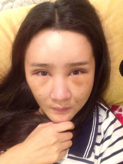 做欧式双眼皮手术要多少钱价格 欧式双眼皮手术前后对比果照片图