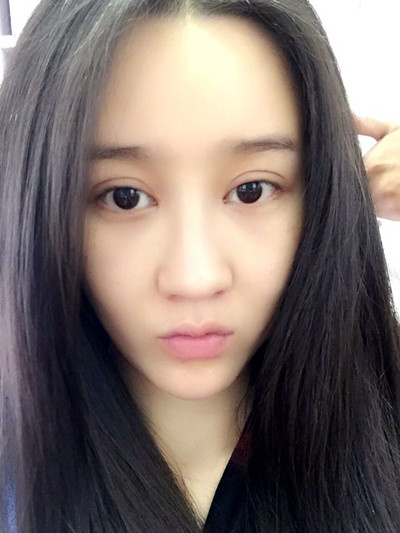 做欧式双眼皮手术要多少钱价格 欧式双眼皮手术前后对比果照片图