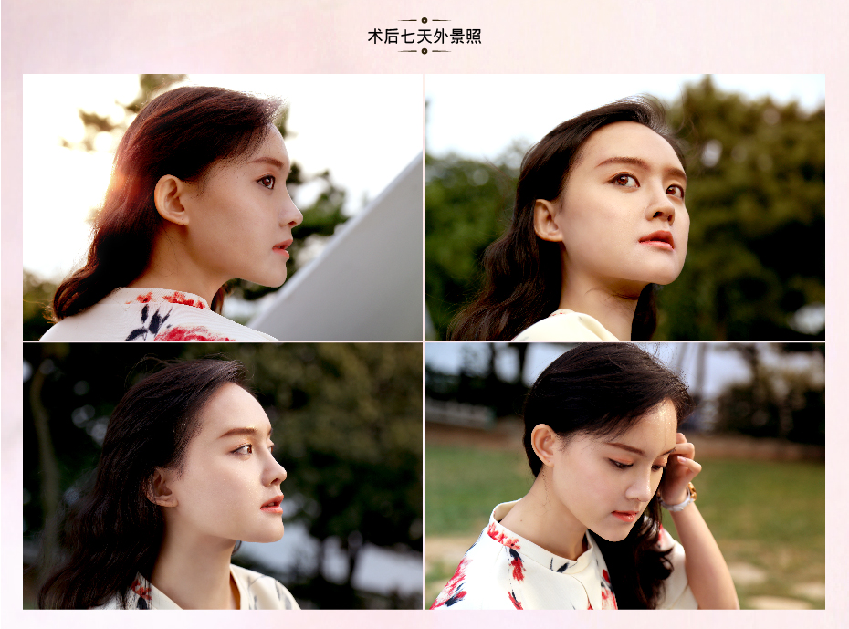 王艇隆鼻手术怎么样 王艇隆鼻手术多少钱价格