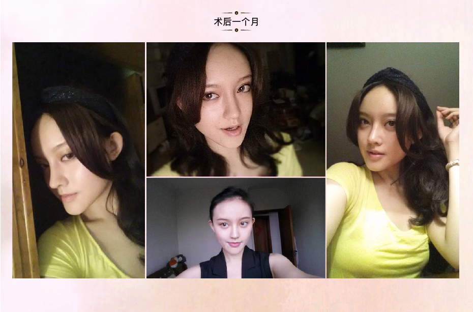 王艇隆鼻手术怎么样 王艇隆鼻手术多少钱价格