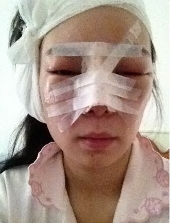 自体肋软骨隆鼻移植术多少钱价格 自体肋软骨隆鼻的后遗症缺点