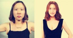 做副乳手术需要多少钱价格 副乳切除手术后果对比照片图