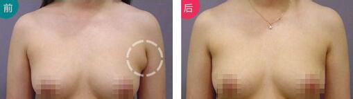 做副乳手术需要多少钱价格 副乳切除手术后果对比照片图