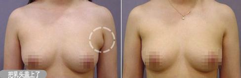 做副乳手术需要多少钱价格 副乳切除手术后果对比照片图