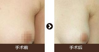 做副乳手术需要多少钱价格 副乳切除手术后果对比照片图