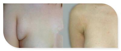 做副乳手术需要多少钱价格 副乳切除手术后果对比照片图