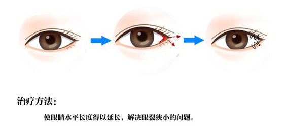 开内眼角手术多久恢复 开内眼角手术会回缩吗