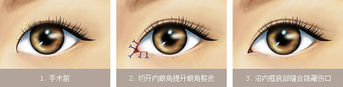 开内眼角手术多久恢复 开内眼角手术会回缩吗