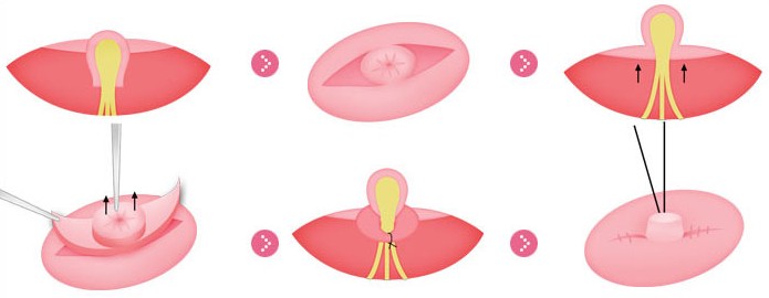 乳头内陷矫正术哪家医院好 乳头内陷矫正术的价格多少钱