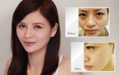 激光收缩毛孔是永.久的吗 激光收缩毛孔大概要多少钱价格