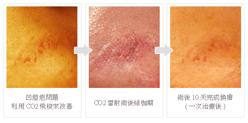 激光收缩毛孔是永.久的吗 激光收缩毛孔大概要多少钱价格