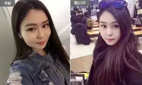打B****Z长能保持多长时间 打B****前后果对比照片图