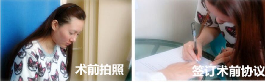假体隆鼻手术后会变形吗 假体隆鼻取出后会变形吗