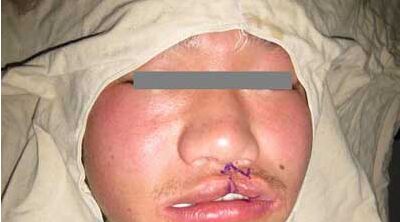 唇裂修复手术需要花多少钱 唇裂修复手术哪家医院喜欢