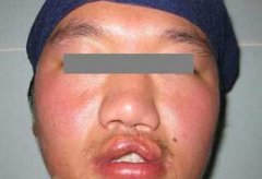 唇裂修复手术需要花多少钱 唇裂修复手术哪家医院喜欢